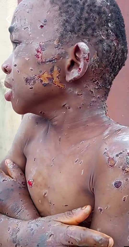 Anambra first lady pledges rehabilitation for 10-year-old assaulted by guardians